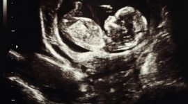 מצוקה עוברית