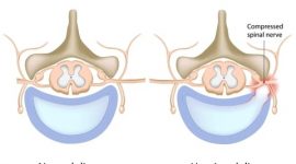 פריצה של הדיסק בגב