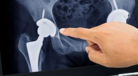 ניתוח החלפת מפרק