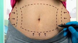 רשלנות בניתוח מתיחת בטן