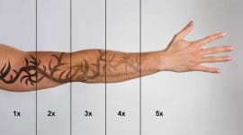 רשלנות בהסרת קעקוע